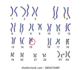 Karyotype of Prader-Willi syndrome, labelled 3D illustration. A genetic disorder caused by a lack of function of part of chromosome 15 inherited from a person's father
