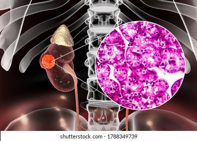 Kidney Cancer, Renal Cell Carcinoma, 3D Illustration And Light Micrograph