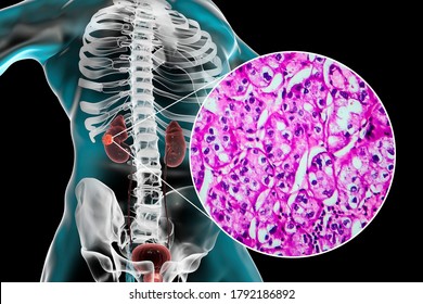 Kidney Cancer, Renal Cell Carcinoma, 3D Illustration And Light Micrograph