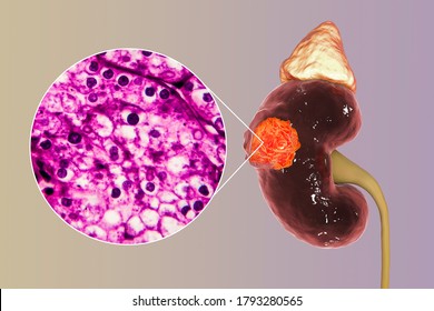 Kidney Cancer, Renal Cell Carcinoma, 3D Illustration And Light Micrograph