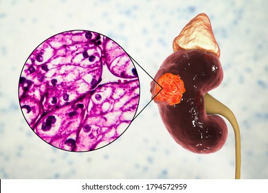 Kidney Cancer, Renal Cell Carcinoma, 3D Illustration And Light Micrograph