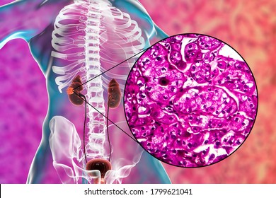 Kidney Cancer, Renal Cell Carcinoma, 3D Illustration And Light Micrograph