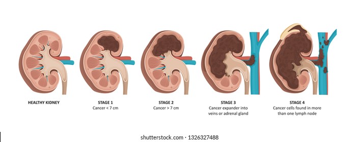 Kidney Cancer Stages. Malignant Tumor Of A Kidney