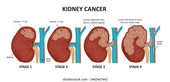 Kidney Cancer Stages. Malignant Tumor Of A Kidney