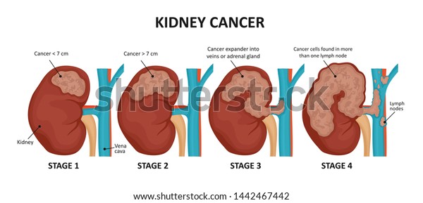 Kidney Cancer Stages Malignant Tumor Kidney Stock Illustration 1442467442