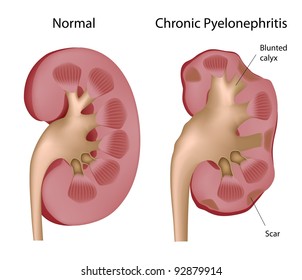 Kidney Chronic pyelonephritis