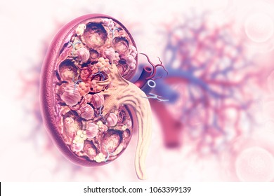Kidney Disease. 3d Illustration