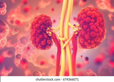Kidney Disease. 3d Illustration