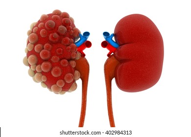 Kidney Disease.3d Illustration