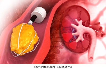 Kidney Stone Removal Concept Background. 3d Illustration 	