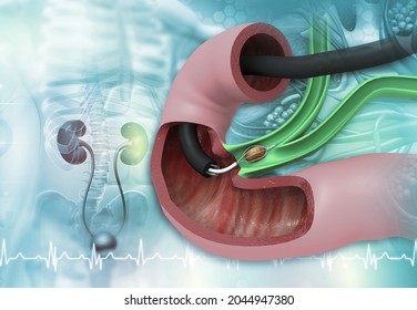 Kidney Stone Removal Concept Background. 3d Illustration