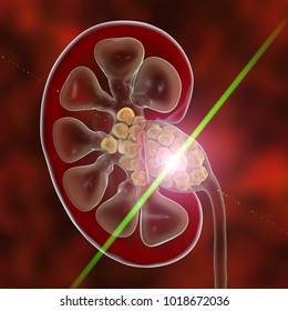 Kidney stones laser treatment concept. Lithotripsy, laserotherapy, 3D illustration