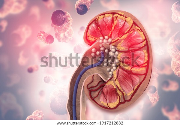 Kidney stones medical concept. Cross\
section. 3d\
illustration