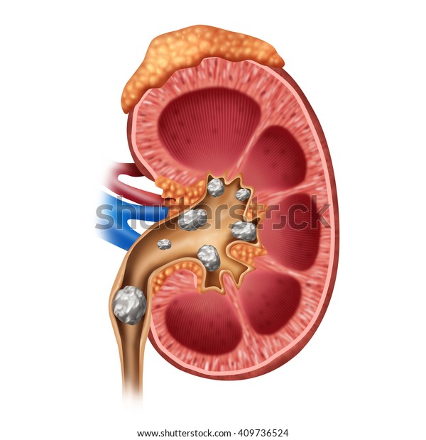 Kidney stones medical concept as a\
human organ with painful crystaline mineral formations as a medical\
symbol with a cross section as a 3D illustration\
style.