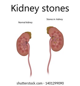 Kidney Stones Normal Healthy Urolithiasis Renal Stock Illustration ...