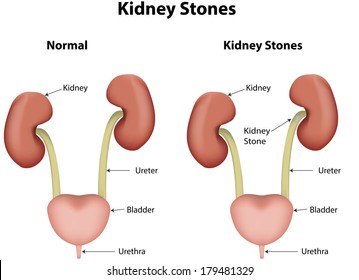 Kidney Stones in the Urinary System
