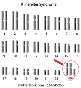  Klinefelter Syndrome