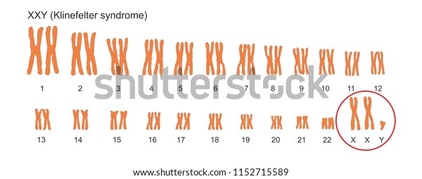 Klinefelter Syndrome Genetic Condition Double Copies Stock Illustration