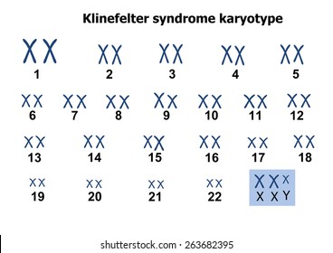 Klinefelter Syndrome Karyotype