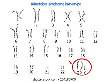 Klinefelter Syndrome Karyotype