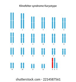 Klinefelter Syndrome (XXY) Human Karyotype	