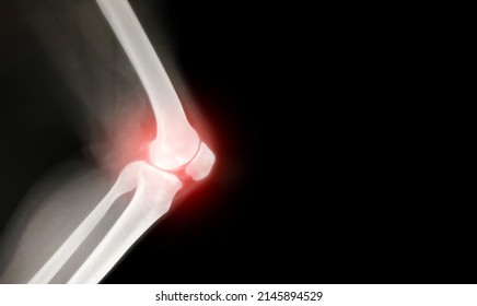 Knee Bone Inflammation Computer X-ray Images