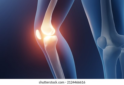 Knee injury, Arthritic knee joint 3d illustration