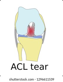 Knee Joint Front View Without Kneecap With ACL Tear