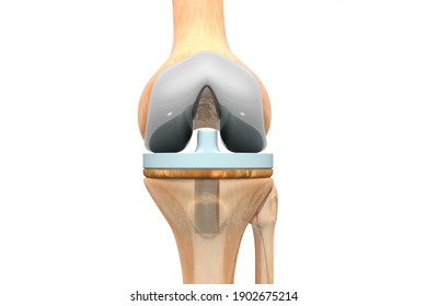 Knee Joint Replacement. 3d Illustration