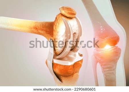 Knee Joint Replacement Surgery. 3d illustration