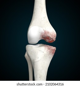 Knee Osteoarthritis 3D Rendering, OA Knee, Knee Pain, Knee Anatomy, Cartilage Damage, Degeneration, 3D Illustration