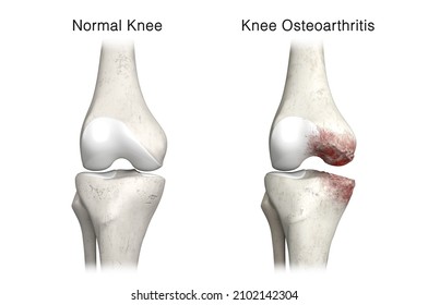 Knee Osteoarthritis 3D Rendering, OA Knee, Knee Pain, Knee Anatomy, Cartilage Damage, Degeneration, 3D Illustration