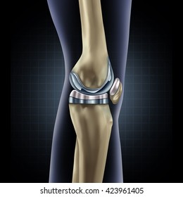 Knee replacement implant medical concept as a human leg anatomy after a prosthetic surgery as a musculoskeletal disease treatment symbol for orthopedics with 3D illustration elements.