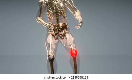 Knee Sprain Or Ache Leading To Pain, Man Suffering From Knee Pain, Healthy Joint And Unhealthy Painful Joint With Osteoarthritis, Xray Hologram Showing Pain Area On The Leg Knee Front, 3d Render