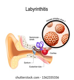 Labyrinthitis. vestibular neuritis. inflammation of the inner ear and virus that caused this disease. Herpes simplex virus. Human anatomy. illustration for medical use