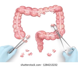 Large Intestine Puzzle Concept: Hands Of Surgeon With Surgical Tools Perform Colon Surgery As A Result Of Diverticulitis, Colitis Ulcerosa, Appendicitis, Crohn's Disease, Colonic Polyp. 3d Rendering