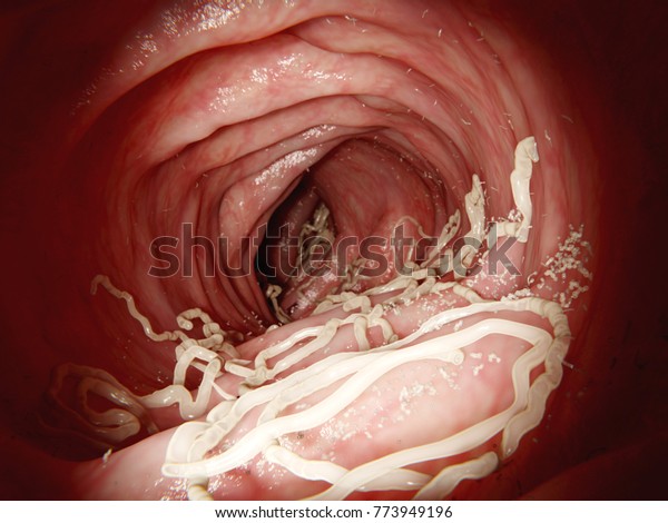 Large\
roundworm in human intestine.\
Ascaris lumbricoides lives in the\
intestines.The larvae penetrate the intestine wall, enter the blood\
stream and infestate several organs. 3d\
rendering