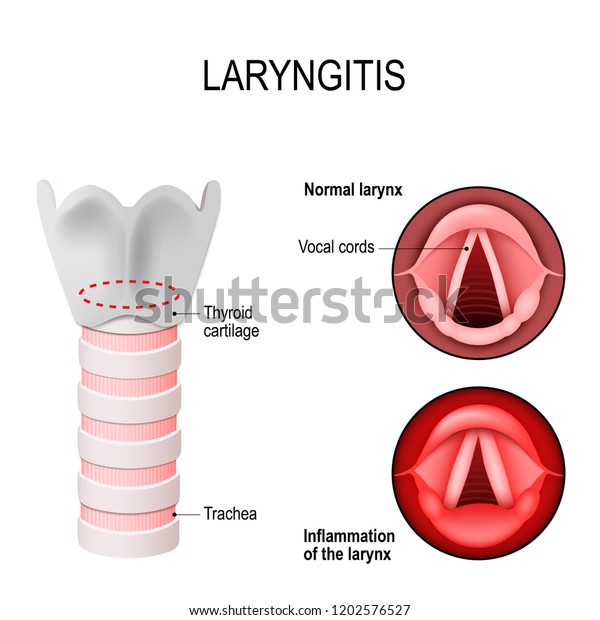 喉頭炎は声箱の炎症です 正常な喉頭と炎症を起こした喉頭 音声ボックスの断面 声帯 甲状軟骨 気管 人間の解剖学 医療用イラスト のイラスト素材