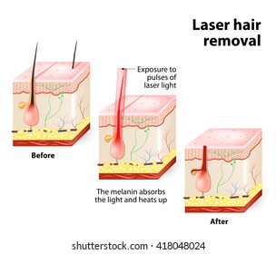 The laser emits an invisible light which penetrates the skin without damaging it. At the hair follicle, laser light absorbed by the pigments is converted into heat. This heat will damage the follicle.