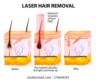 Laser Hair Removal.