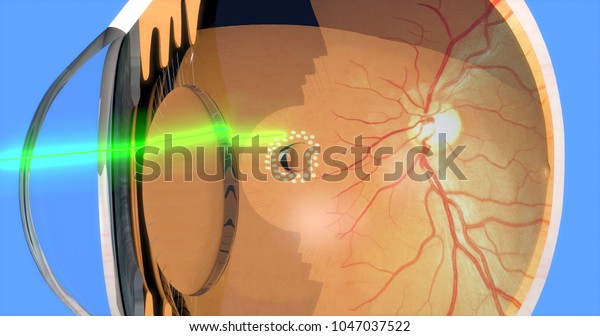 Laser Photocoagulation Around Retinal Tear 3d Stock Illustration ...