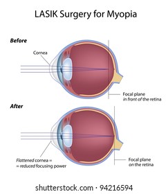 Lasik Eye Surgery For Myopia