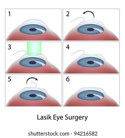 Lasik Eye Surgery Procedure