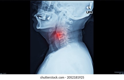 
Lateral Projection Cervical Spine X-ray Showing Anterior Cervical Discectomy And Fusion Or ACDF Procedure. 