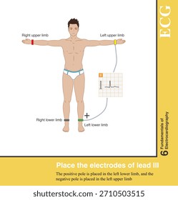 Lead Ⅲ is a standard limb lead, with the positive pole placed in the left lower limb and the negative pole placed in the left upper limb.