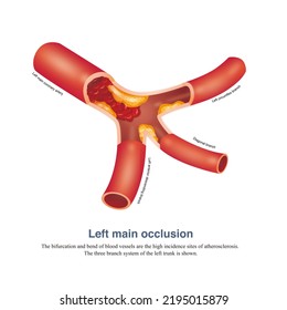 Left Main Artery Occlusion Is The Most Serious Acute Coronary Syndrome. Patients Can Die Of Cardiac Arrest, Cardiogenic Shock And Left Heart Failure In A Short Time.