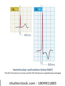 58 Left ventricular wall Images, Stock Photos & Vectors | Shutterstock