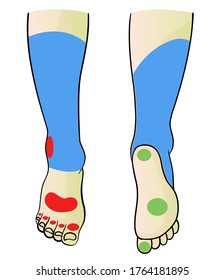 Leg Ulcer : Red Spot Arterial Ulcer , Green Spot Diabetic Ulcer , Blue Spot  Venous Ulcer 