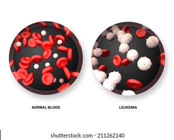 Leukemia Vs Normal Blood