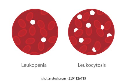 224 Leukocytosis Images, Stock Photos & Vectors | Shutterstock